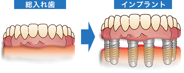 インプラント | 香川県高松市の歯医者 JUN歯科クリニック | 医療法人